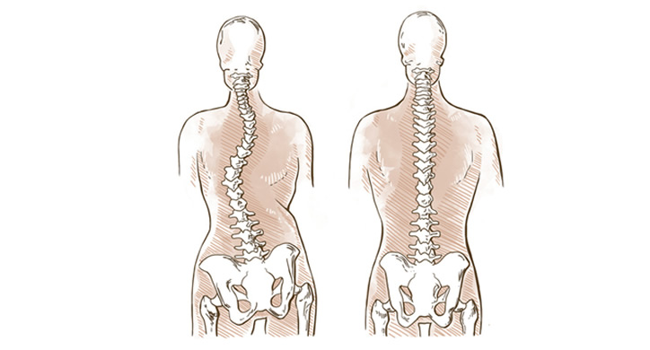scoliosi asimmetria